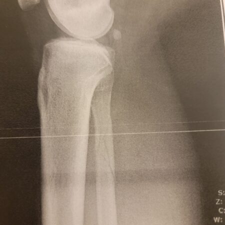 Hokkaido Ski Accident (Part 1): Breaking a bone and tearing ligaments