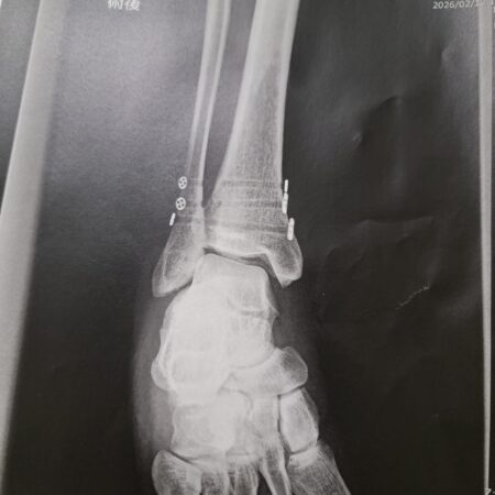 Hokkaido Ski Accident (Part 3): The surgery pain-cave